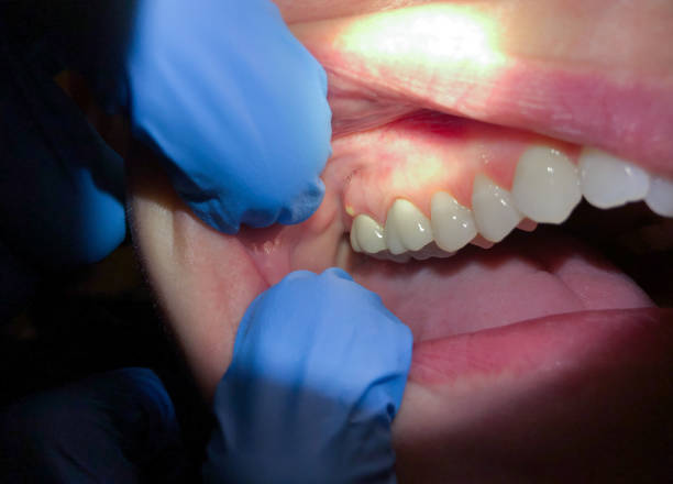Best Emergency Dental Filling Replacement  in Mcgovern, PA